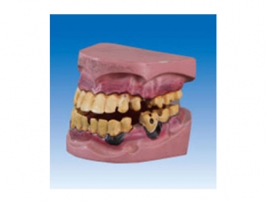 ZM2071 牙齿病理模型