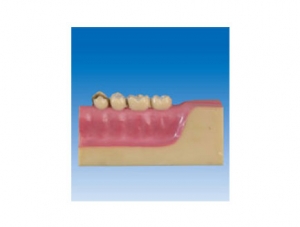 中卫ZM2068 牙齿病理模型