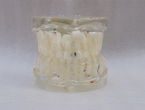 ZM-A12_C11乳恒牙交替带龋齿