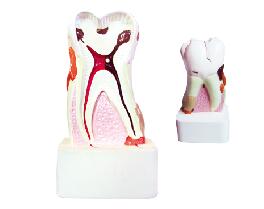 ZM1049-6 牙体病理模型