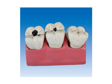 ZM2069 牙齿病理模型