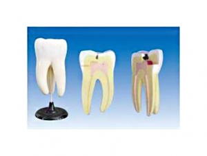 ZM1049-9 Maxillary three-root caries model