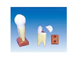 ZM1049-9 Maxillary three-root caries model