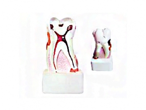 世界各地ZM1049-6 dental pathology model