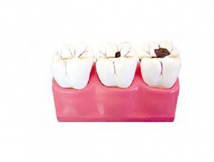 ZM1049-5 caries decomposition model