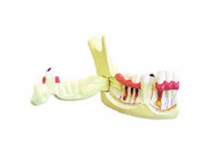 ZM1049-4 Decomposition model of lower right posterior teeth