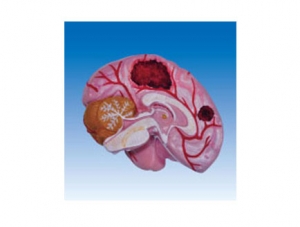 ZM2107 Brain Lesion Model