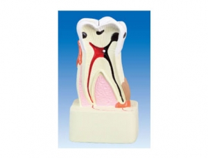 ZM2070 Tooth Pathology Model