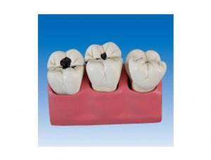 ZM2069 Tooth Pathology Model