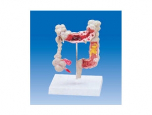 ZM2004 Colon and rectal common disease model