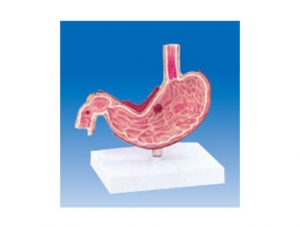 ZM2009 Sick stomach anatomical model
