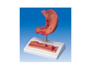 ZM2010 Stomach Pathology (with Diaphragm), 2 Parts