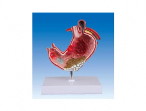 ZM2011 Sick stomach anatomical model