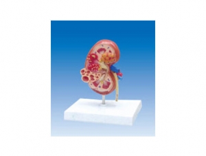 ZM2042 Kidney Cyst Anatomical Model