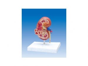 ZM2042 Kidney Cyst Anatomical Model