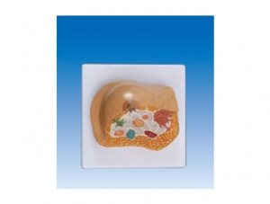 ZM2043 Pathological Breast Model