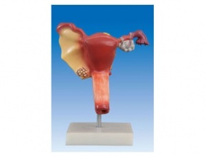 ZM2052 Sick Uterus Model