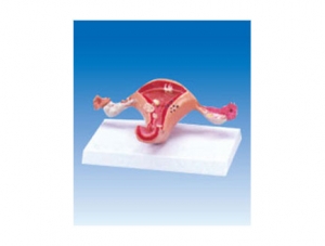 ZM2053 Sick Uterus Model