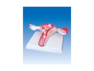 ZM2054 Sick Uterus Model