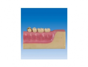 ZM2068 Tooth Pathology Model