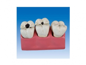 ZM2069 Tooth Pathology Model