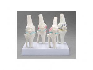 ZMJY/A3008 Knee joint health morbidity comparison model