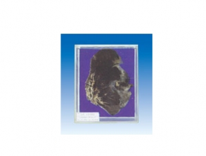 lobar hepatitis