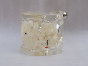 ZM-A12-01_C11 deciduous permanent teeth with alternating caries