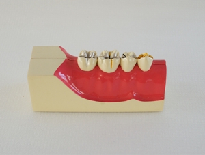 ZM-D4_M9 right lower tooth tissue decomposition