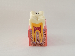 ZM-DSC02101_M2 six times caries comparison