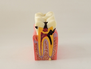 ZM-DSC02102_M2 six times caries comparison