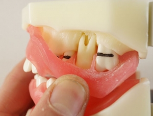 ZM-DSC02186_L5 periodontal disease model