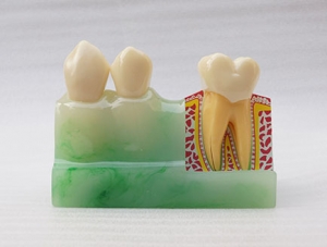 ZM-DSC02394_M4 Quadruple Tooth Decomposition
