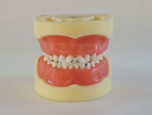 ZM-U10_E10 model of caries in children